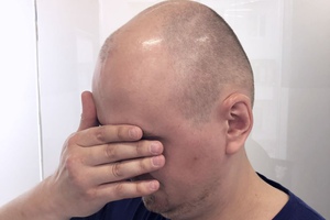 Проблема "высокого лба" после пересадки волос